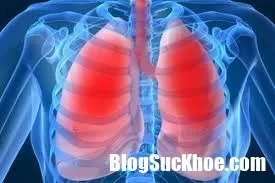 Cẩn thận với chứng viêm phổi lúc trời chuyển lạnh