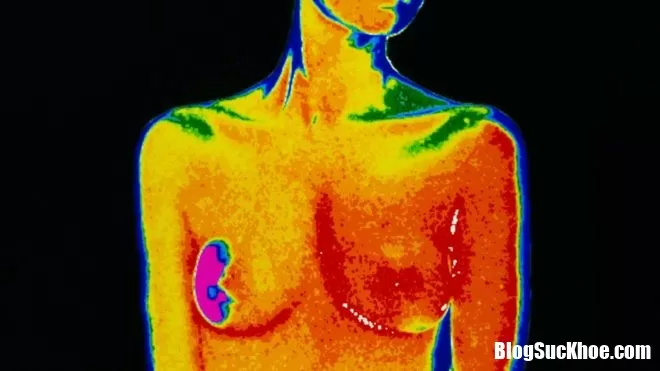 15 Năm ngưng điều trị ung thư vú vẫn có thể tái phát