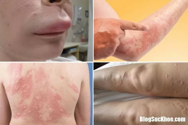 Cách xử lý khi bị nổi mề đay ngày trở lạnh