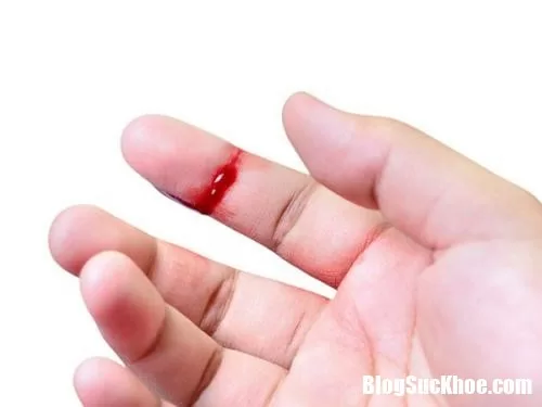 Bệnh máu khó đông - Nguyên nhân và triệu chứng