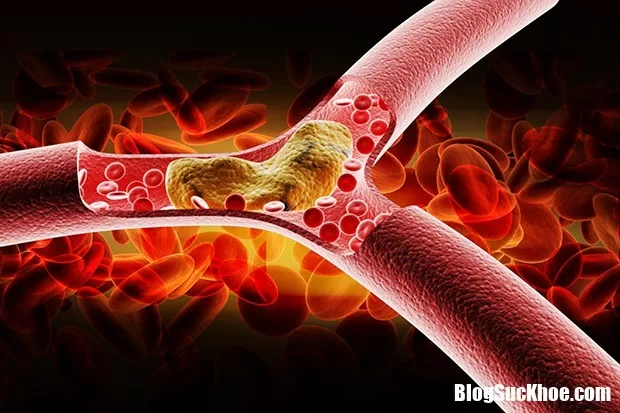 Người khỏe mạnh cũng có thể mắc bệnh mỡ máu cao