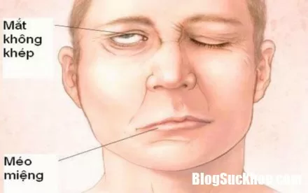 Cách xử lý khi bị méo miệng, liệt mặt để tránh hậu quả khôn lường