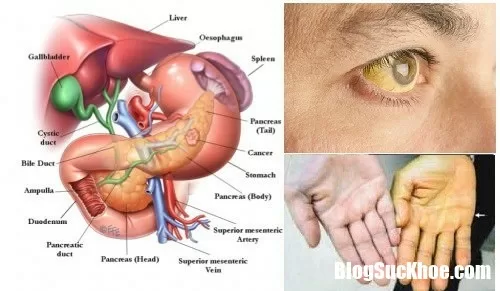 Những dấu hiệu của ung thư tuyến tụy cần cảnh giác