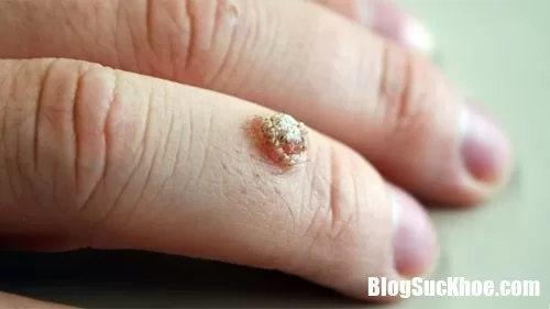 Cách điều trị mụn cóc cực đơn giản mà hiệu quả