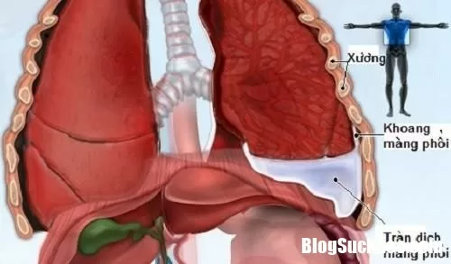 Cần kiên trì khi chăm sóc bệnh nhân tràn dịch màng phổi