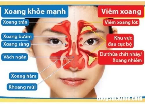 Viêm xoang cấp và mãn tính phân biệt thế nào ?