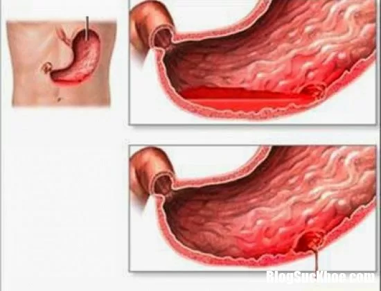 Nguyên nhân và triệu chứng của bệnh xuất huyết dạ dày