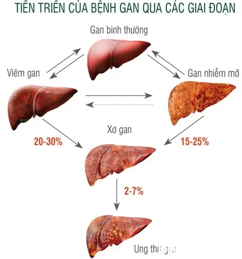 Việt Nam là nước có tỷ lệ xơ gan và ung thư gan cao nhất