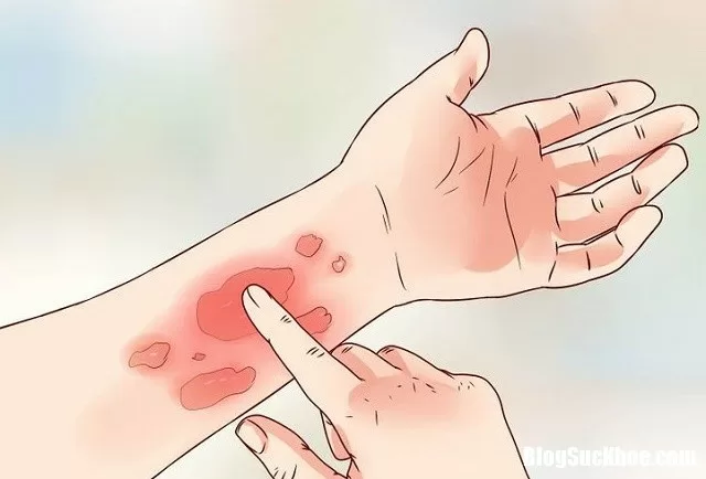 Cách khắc phục tình trạng da ngứa mùa lạnh