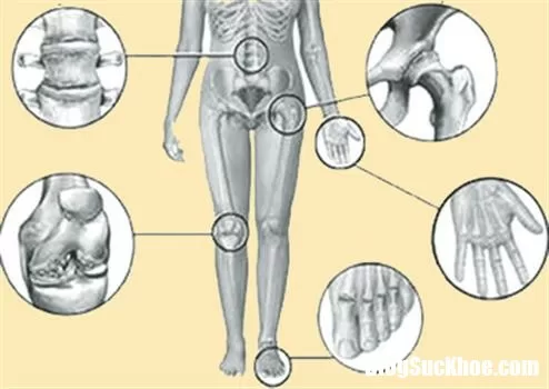 Giải đáp những thắc mắc xung quanh bệnh viêm khớp