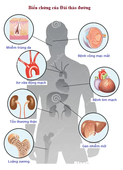 Bệnh đái tháo đường và những biện pháp phòng ngừa biến chứng