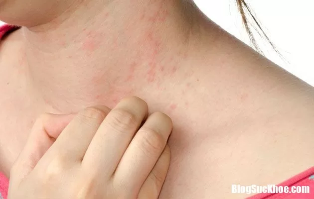 Những triệu chứng cảnh báo căn bệnh ung thư da nên đi khám ngay