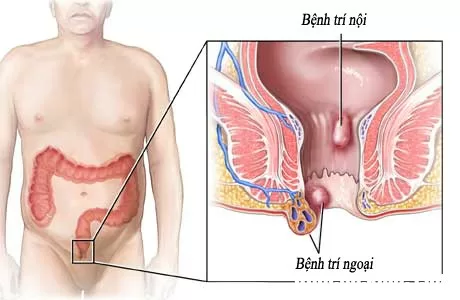 Nguyên nhân và cách phòng ngừa bệnh trĩ