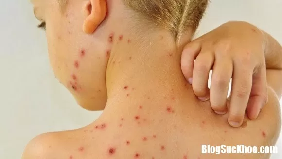Triệu chứng và cách phòng tránh bệnh thủy đậu