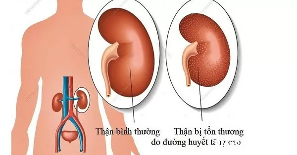 Người bị mắc bệnh về thận có nguy cơ cao bị bệnh đái tháo đường