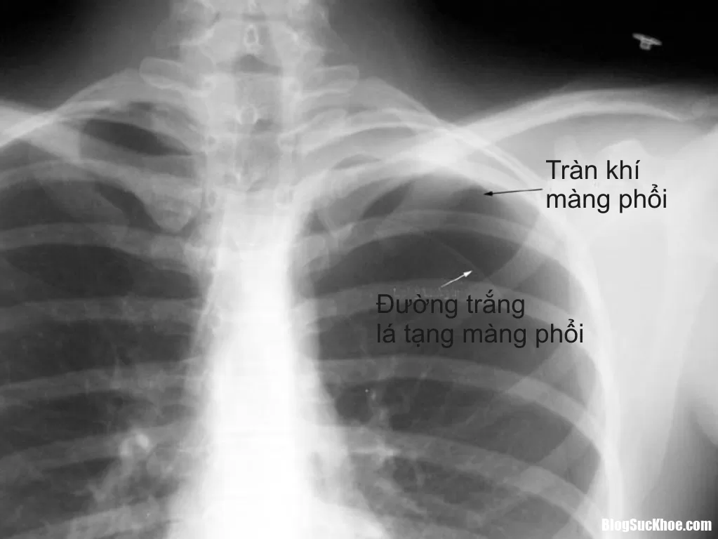 Nguyên nhân và cách điều trị tràn khí màng phổi