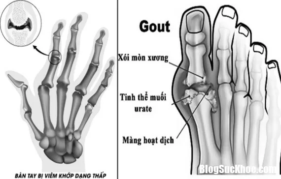 Cách phòng ngừa các bệnh xương khớp dễ mắc mùa đông – xuân