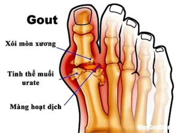 Những biến chứng nguy hiểm của bệnh gút