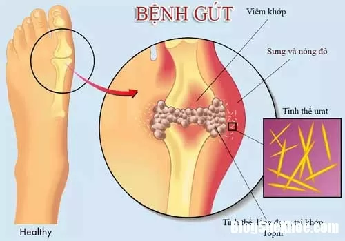 Nguyên nhân và cách điều trị bệnh gout