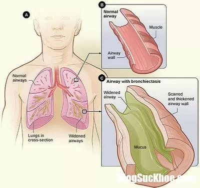 Người nào dễ bị giãn phế quản?