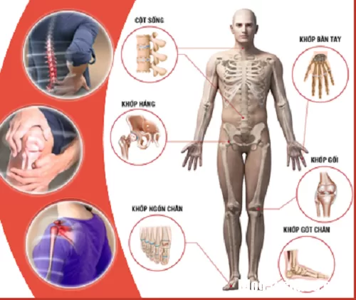 Bệnh cơ xương khớp chính là nguyên nhân chính gây tàn phế