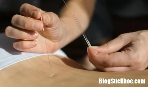 Chữa đau thần kinh tọa bằng cách châm cứu, bấm nguyệt