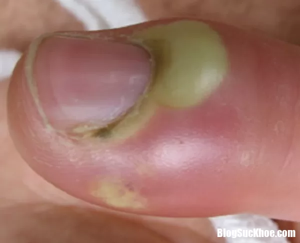 Cách đơn giản chữa chín mé dứt điểm ngay tại nhà