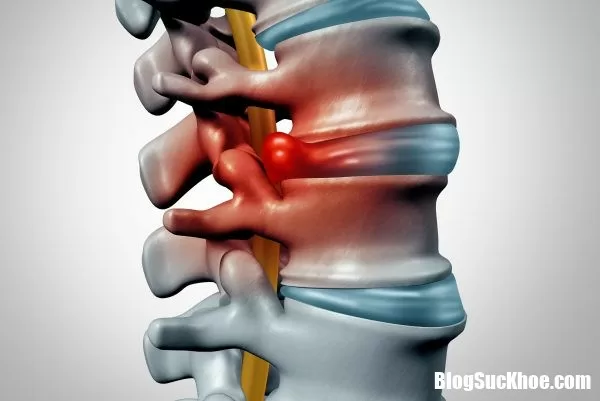 Dấu hiệu thường thấy giúp nhận biết bệnh thoát vị đĩa đệm