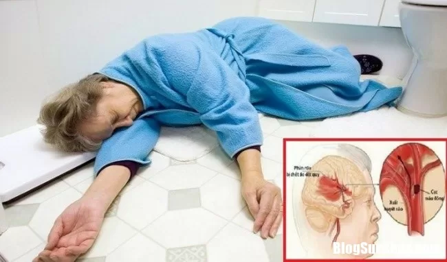 Phòng ngừa đột quỵ không khó như ta vẫn nghĩ