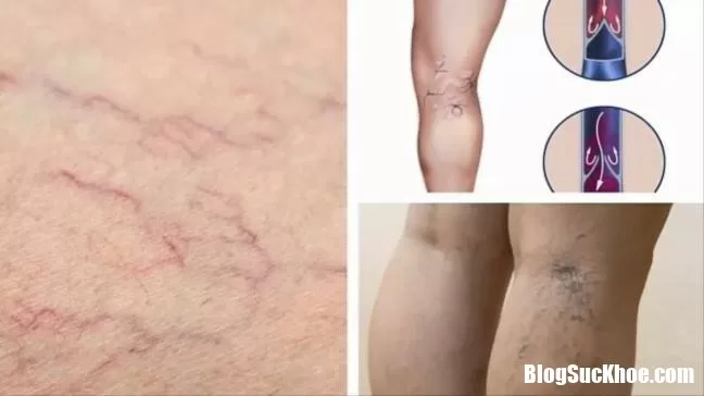 Những điều cần lưu ý về giãn tĩnh mạch chân