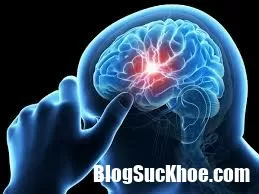 Cách nhận biết sớm bệnh tai biến mạch máu não