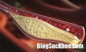 Những biến chứng nguy hiểm do máu nhiễm mỡ gây ra