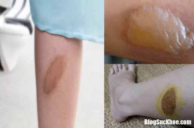 Cách xử lý khi bị bỏng bô xe máy