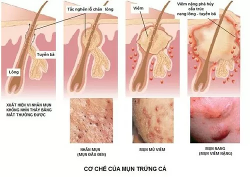 Mụn trứng cá có dấu hiệu nhiễm trùng phải làm sao ?