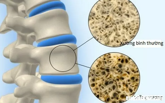 Những bệnh có nguy cơ loãng xương tăng cao