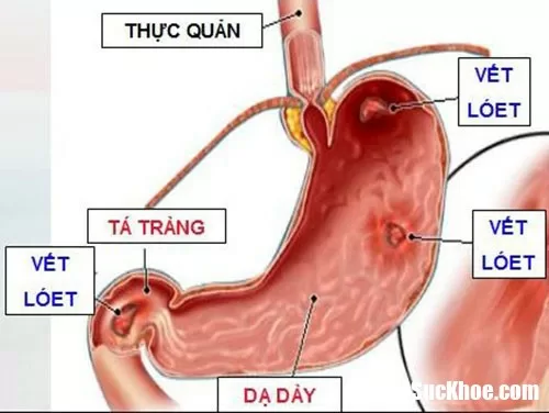 Những loại thuốc gây hại dạ dày cần biết
