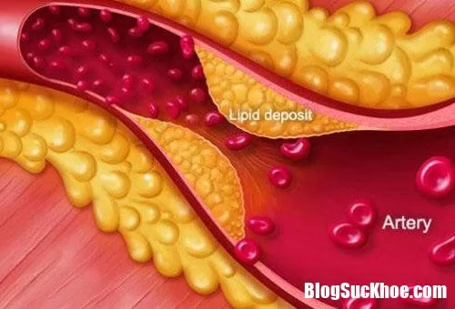 Như thế nào là máu nhiễm mỡ ?