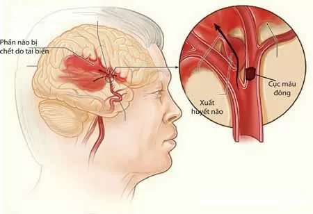 Những triệu chứng của bệnh xuất huyết não ở người già