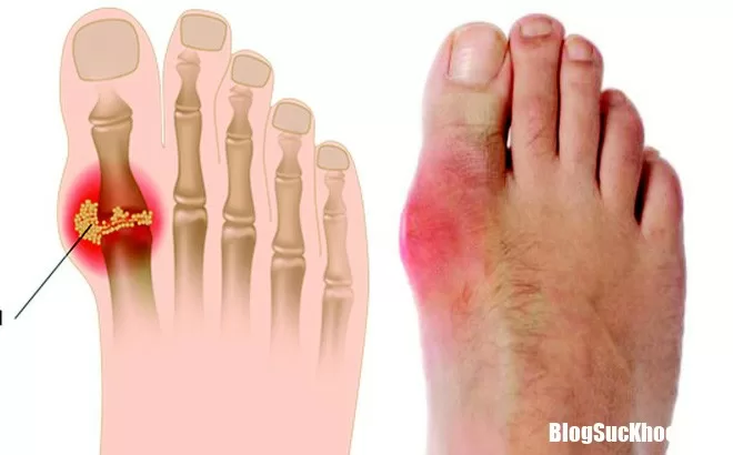 Hãy nhớ công thức "5 nên, 4 tránh" khi điều trị căn bệnh gút