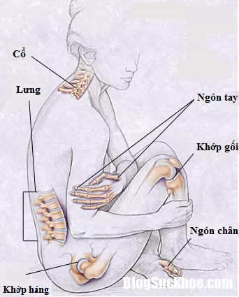 Những thông tin bổ ích về bệnh thoái hóa khớp