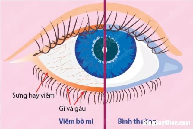 Làm việc với máy tính quá nhiều khiến bệnh viêm bờ mi tăng cao