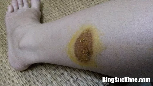 Mẹo xử lý bỏng bô xe máy để tránh sẹo mất thẩm mỹ