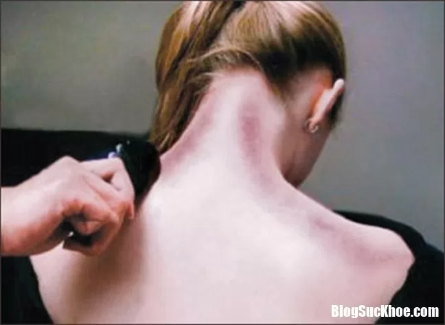 Như thế nào là bị trúng gió ?