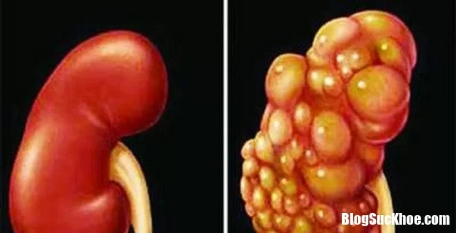 Ung thư thận di căn sẽ nguy hiển như thế nào ?