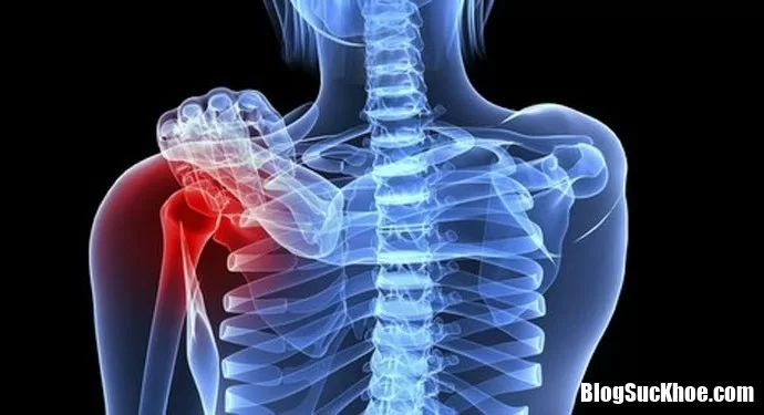 Cách nhận biết bệnh ung thư xương