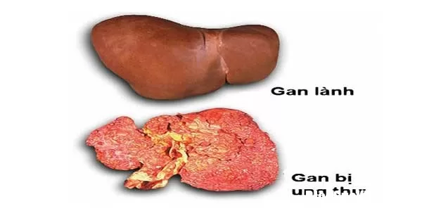 Những triệu chứng biểu hiện của bệnh ung thư gan
