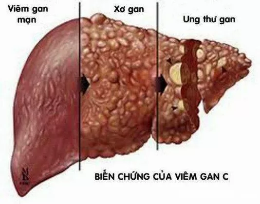 Viêm gan C nguy hiểm đến mức nào ?