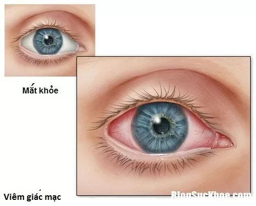 Nên điều trị sớm viêm giác mạc để tránh mù lòa