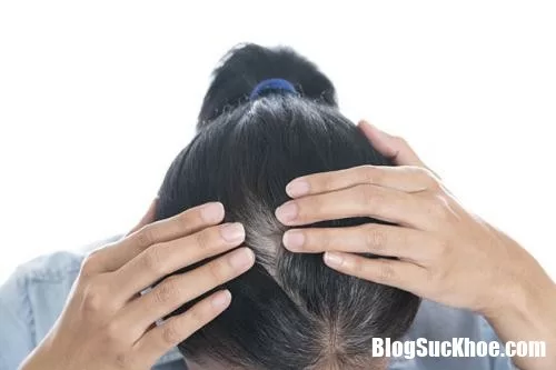 Nếu tóc bạc sớm bạn hãy nghĩ ngay đến 4 căn bệnh sau