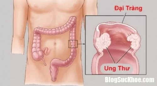 Dấu hiệu, triệu chứng nhận biết bệnh ung thư đại tràng